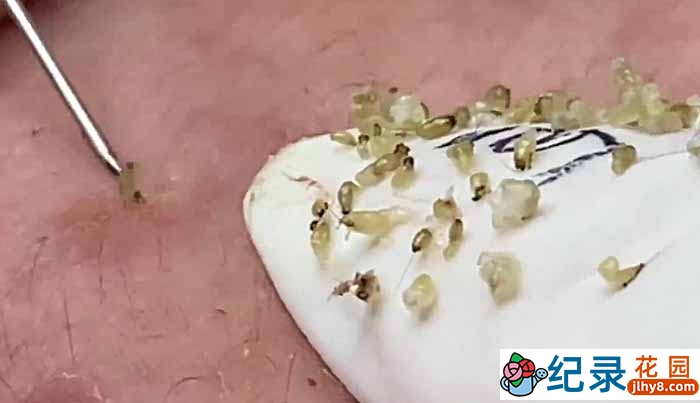 健康解压纪录片《祛黑痘》全1季原版无字 1080高清纪录片解说素材百度云盘下载插图 健康解压纪录片《祛黑痘》全1季原版无字 1080高清纪录片解说素材百度云盘下载