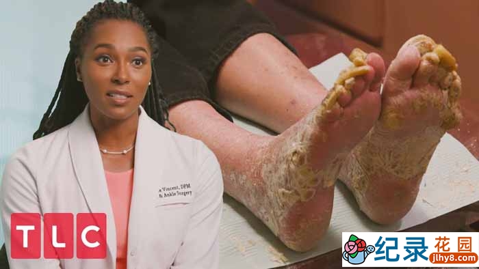 脚部疾病手术纪录片《我的脚要了我的命 My Feet Are Killing Me》第2季中字 1080P高清纪录片解说素材百度云盘下载插图 脚部疾病手术纪录片《我的脚要了我的命 My Feet Are Killing Me》第2季中字 1080P高清纪录片解说素材百度云盘下载