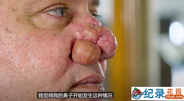 外科手术纪录片《肿瘤医生》第1季中字 1080高清纪录片解说素材百度云盘下载插图 外科手术纪录片《肿瘤医生》第1季中字 1080高清纪录片解说素材百度云盘下载