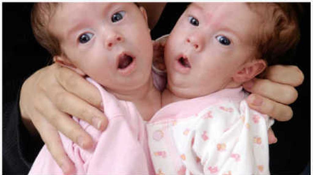 异于常人:连体人 Inside Extraordinary Humans: Science of Conjoined Twins