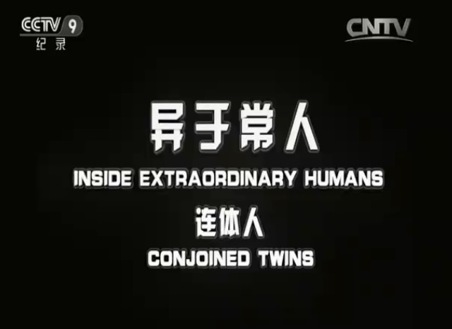 异于常人:连体人 Inside Extraordinary Humans: Science of Conjoined Twins