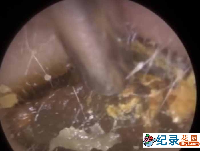 健康解压纪录片《深挖巨型耳垢》第2季原版无字 1080高清纪录片解说素材百度云盘下载