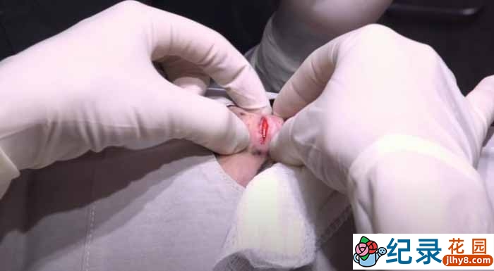 外科手术纪录片《肿瘤医生》第3季中字 1080高清纪录片解说素材百度云盘下载