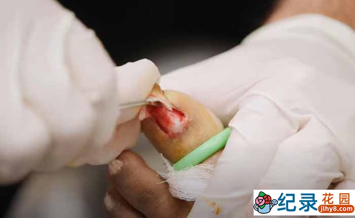 脚部疾病手术纪录片《我的脚要了我的命 My Feet Are Killing Me》短视频合集中字 1080P高清纪录片解说素材百度云盘下载