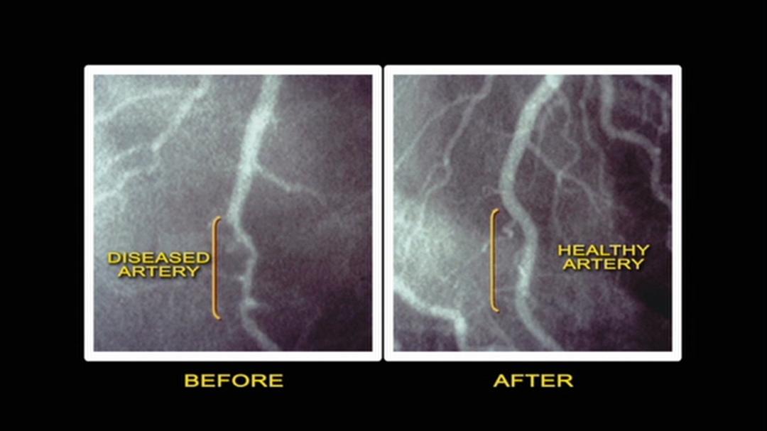 刀叉下的秘密 Forks Over Knives