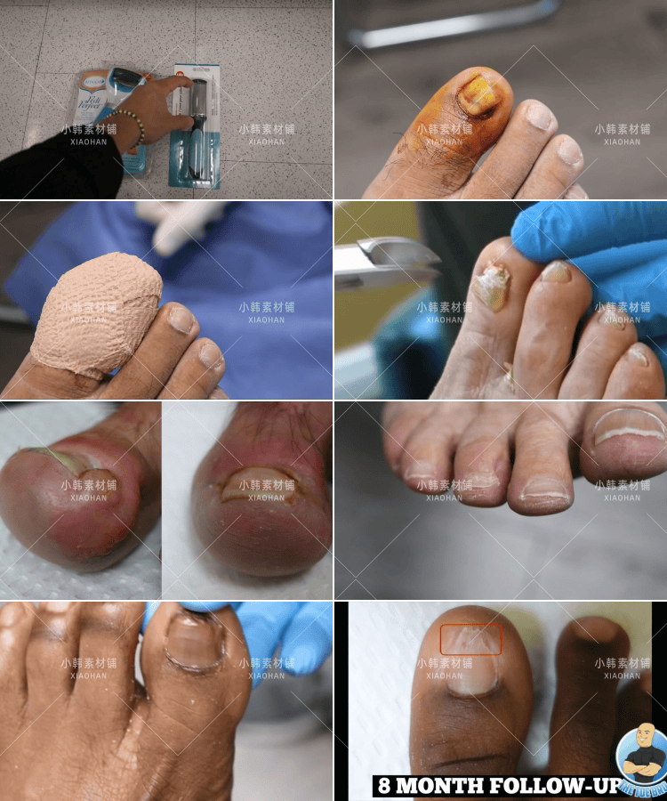 国外高清修脚修死皮剪脚指甲减压视频治愈舒适解压自媒体视频素材