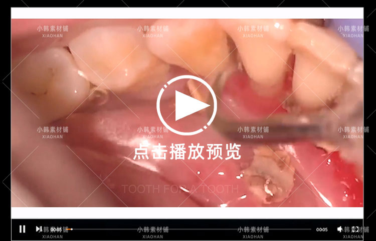 生活解压纪录片清洗牙结石全1季中视频自媒体解说高清视频素材