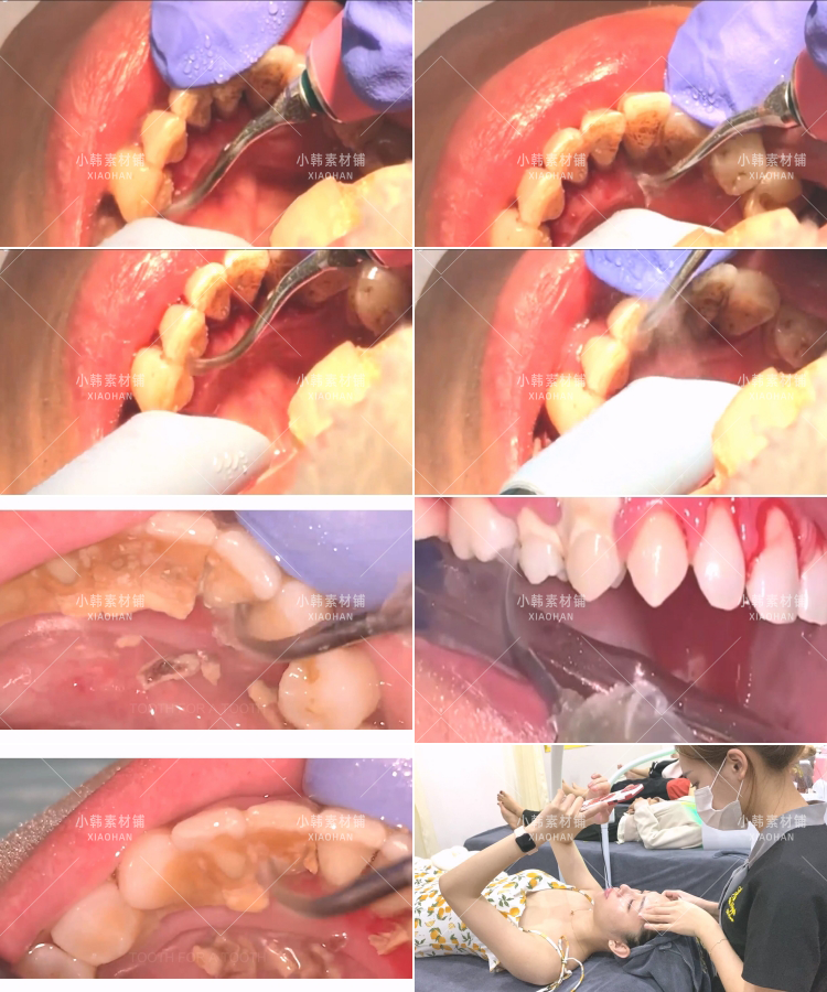 生活解压纪录片清洗牙结石全1季中视频自媒体解说高清视频素材