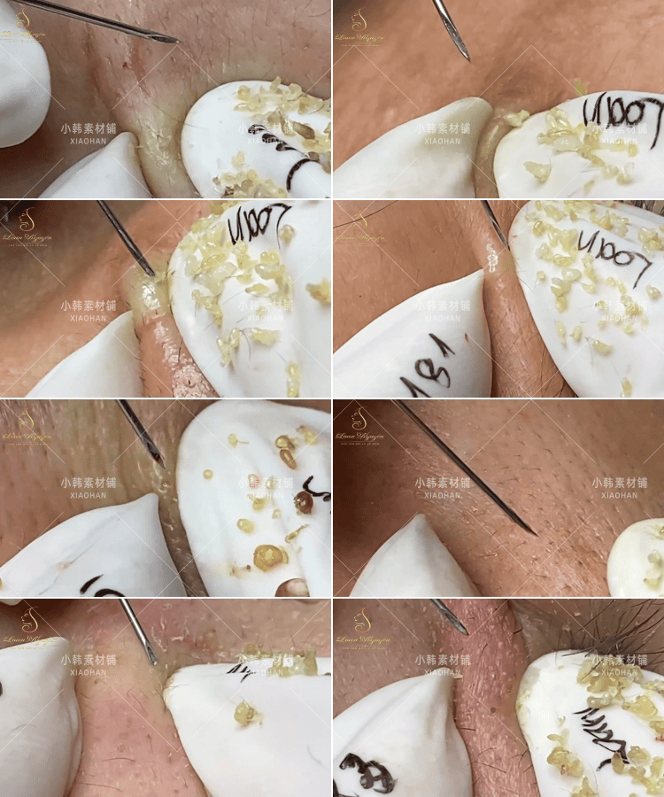 挤痘痘挤去黑头去螨虫国外原声解压减压思维书单高清短视频素材