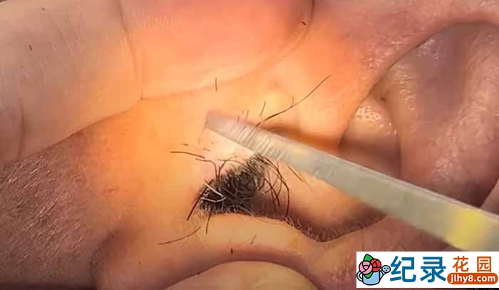 掏耳屎解压纪录片《越南采耳医生》第3季原版无字 1080P高清自媒体解说素材百度云盘下载