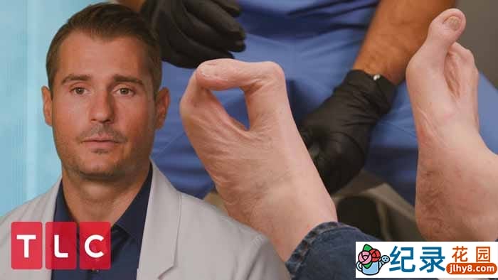 脚部疾病手术纪录片《我的脚要了我的命 My Feet Are Killing Me》第1季中字 1080P高清纪录片解说素材百度云盘下载