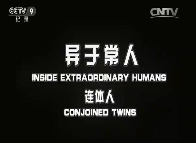 异于常人：连体人 Inside Extraordinary Humans: Science of Conjoined Twins