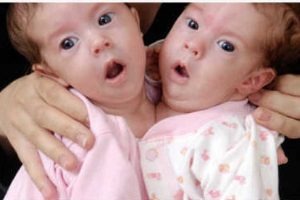 异于常人：连体人 Inside Extraordinary Humans: Science of Conjoined Twins