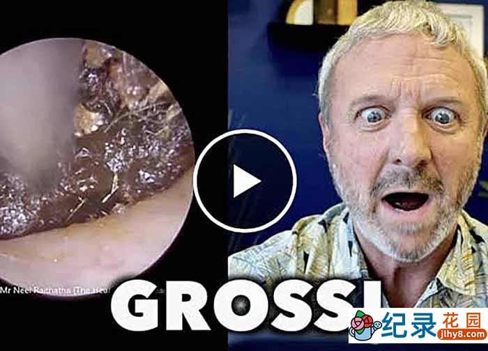 健康解压纪录片《深挖巨型耳垢》第1季原版无字 1080高清纪录片解说素材百度云盘下载