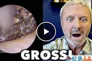 健康解压纪录片《深挖巨型耳垢》第1季原版无字 1080高清纪录片解说素材百度云盘下载