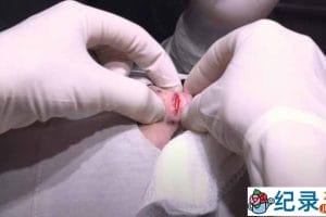 外科手术纪录片《肿瘤医生》第3季中字 1080高清纪录片解说素材百度云盘下载