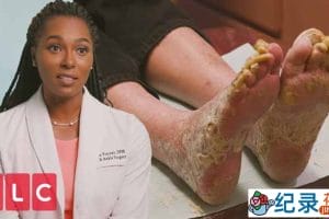 脚部疾病手术纪录片《我的脚要了我的命 My Feet Are Killing Me》第2季中字 1080P高清纪录片解说素材百度云盘下载