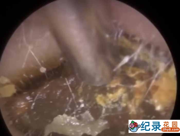 健康解压纪录片《深挖巨型耳垢》第2季原版无字 1080高清纪录片解说素材百度云盘下载