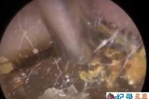 健康解压纪录片《深挖巨型耳垢》第2季原版无字 1080高清纪录片解说素材百度云盘下载