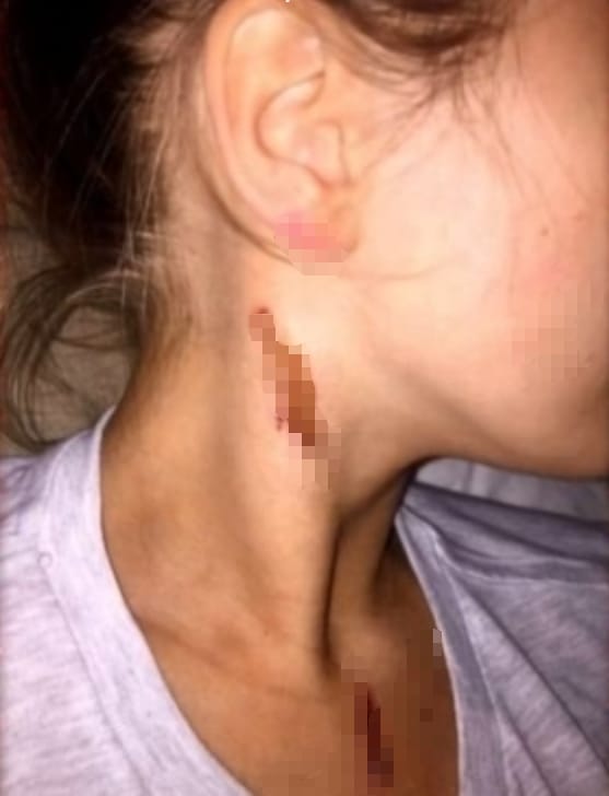 英国泼酸袭击 Acid Attacks How Scared Should We Be