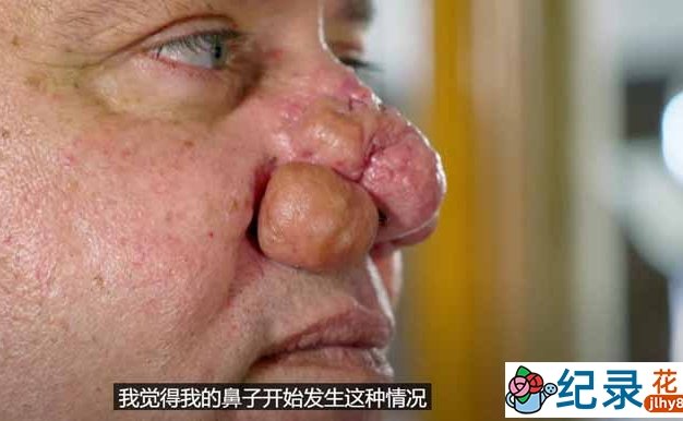 外科手术纪录片《肿瘤医生》第1季中字 1080高清纪录片解说素材百度云盘下载