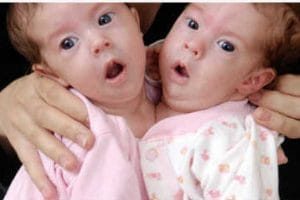 异于常人：连体人 Inside Extraordinary Humans: Science of Conjoined Twins
